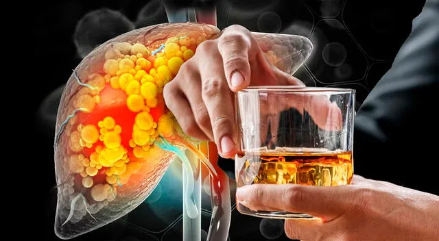 El hígado deja de funcionar y regenerarse en pacientes con hepatitis alcohólica y cirrosis.