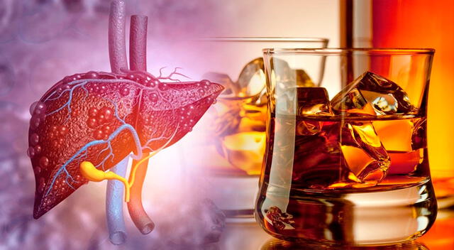 En pacientes con enfermedad hepática relacionada al alcohol, el hígado pierde la capacidad de regenerarse. 