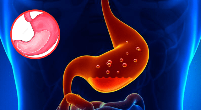 Cambios simples como evitar acostarse después de comer y reducir alimentos ácidos pueden aliviar significativamente el reflujo.