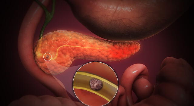Pancreatitis Pancreatitis