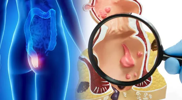 El cáncer anal asociado al VPH suele avanzar de forma silenciosa y lenta. El cáncer anal asociado al VPH suele avanzar de forma silenciosa y lenta.