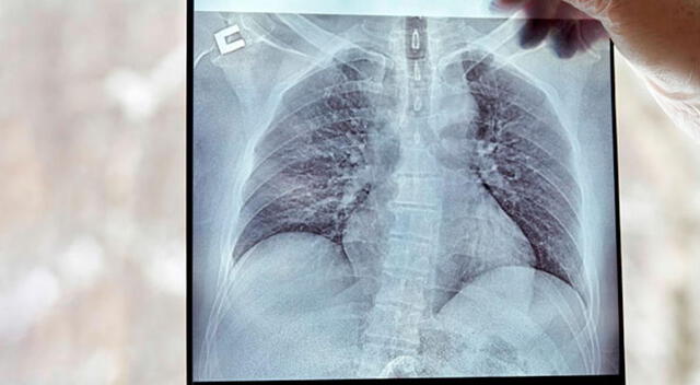 Envejecimiento de pulmones Envejecimiento de pulmones