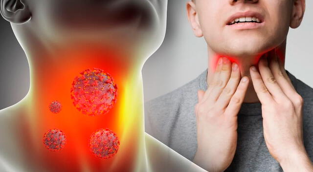 Ganglios linfáticos inflamados en el cuello, una señal común que podría alertar sobre un linfoma.