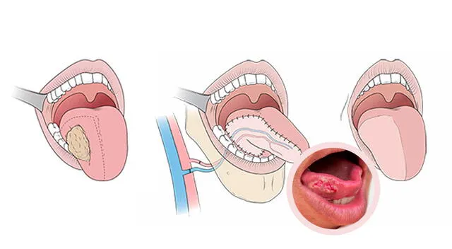Una llaga en la lengua que no cicatriza puede ser una señal temprana de cáncer oral, según especialistas. Una llaga en la lengua que no cicatriza puede ser una señal temprana de cáncer oral, según especialistas.