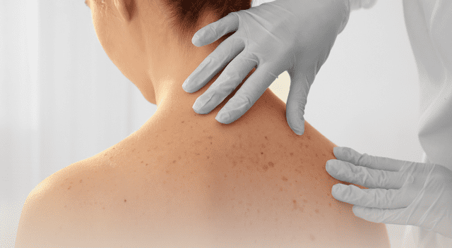 El cáncer de piel ocurre cuando ciertas células cutáneas comienzan a crecer de forma descontrolada. El cáncer de piel ocurre cuando ciertas células cutáneas comienzan a crecer de forma descontrolada.