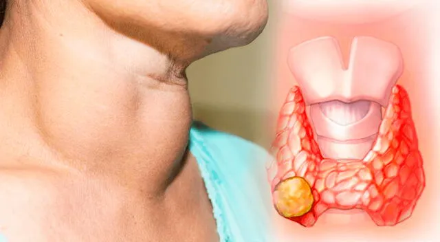 El cáncer de tiroides es una proliferación anormal de células en la glándula tiroidea que puede crecer lentamente o de forma agresiva.