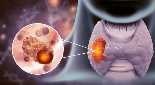 Detectar un tumor maligno en la tiroides en sus primeras etapas aumenta las posibilidades de un tratamiento exitoso 
