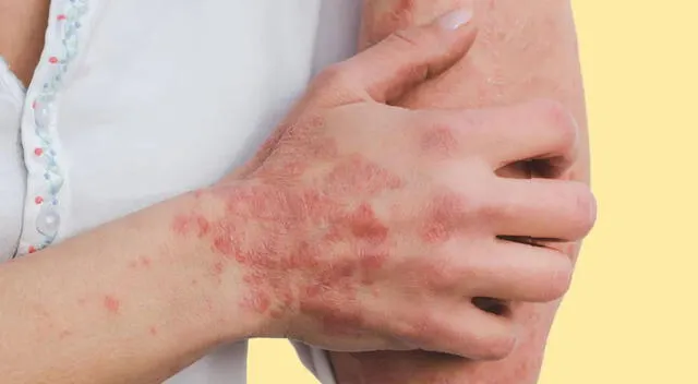 psoriasis psoriasis