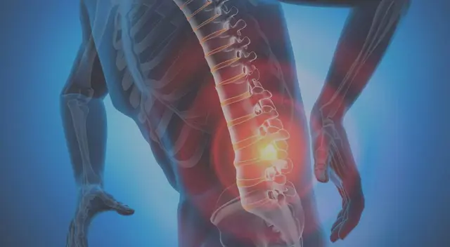 Hernia discal