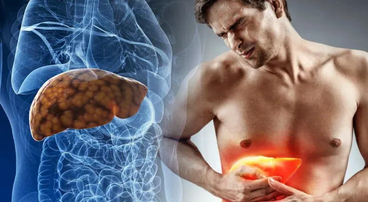 Hígado graso: síntomas clave y cómo prevenirlo a tiempo.