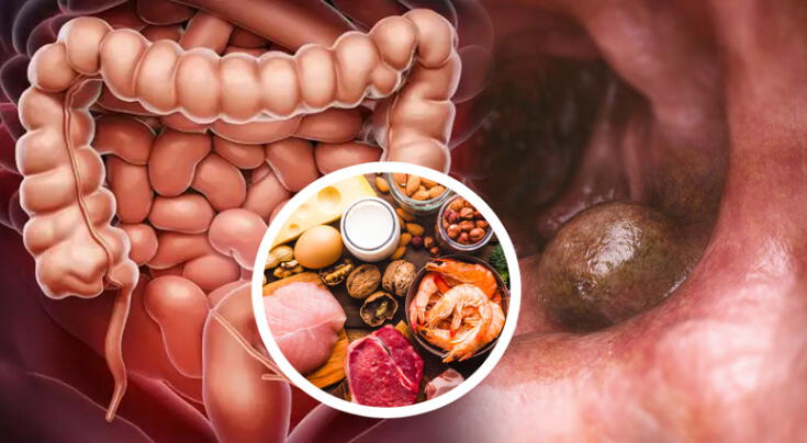 La falta de una proteína clave, posible causa del cáncer de colon.