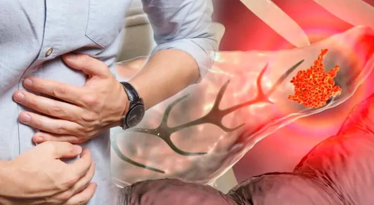 Científicos descubren cómo frenar el cáncer de páncreas.