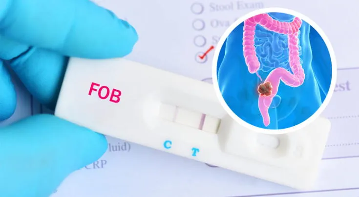 Este test puede prevenir el cáncer de colon y es esencial a partir de los 50 años.