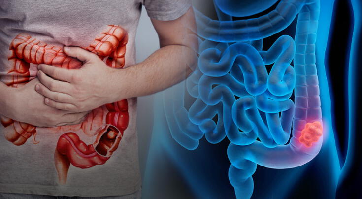 Científicos detectan bacteria intestinal vinculada al cáncer colorrectal en jóvenes.