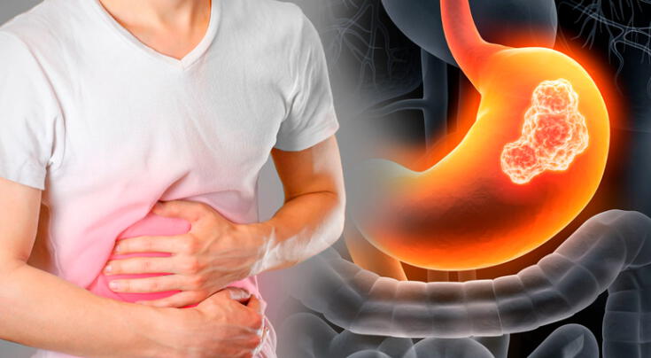 Conoce los primeros síntomas del cáncer al estómago.