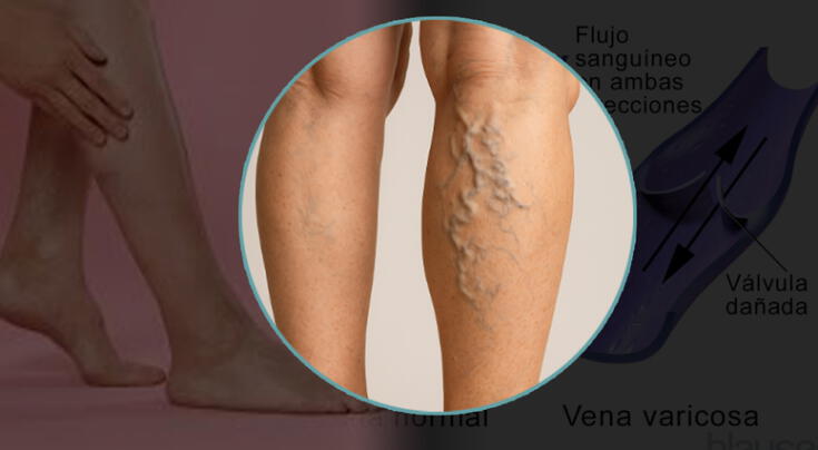 ¿Qué son las várices?