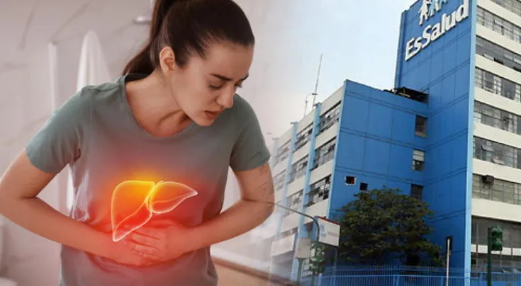 EsSalud advierte sobre el incremento de casos de cirrosis hepática en el país.
