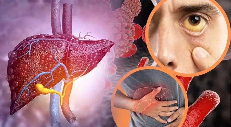 Descubre qué es la hepatitis, sus tipos más frecuentes y los síntomas que pueden pasar desapercibidos.