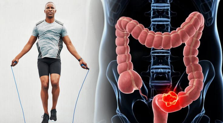 Un nuevo estudio revela que el ejercicio físico mejora significativamente la recuperación en pacientes con cáncer de colon.