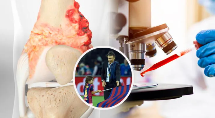 Un estudio en España reveló qué impulsa el avance del osteosarcoma.