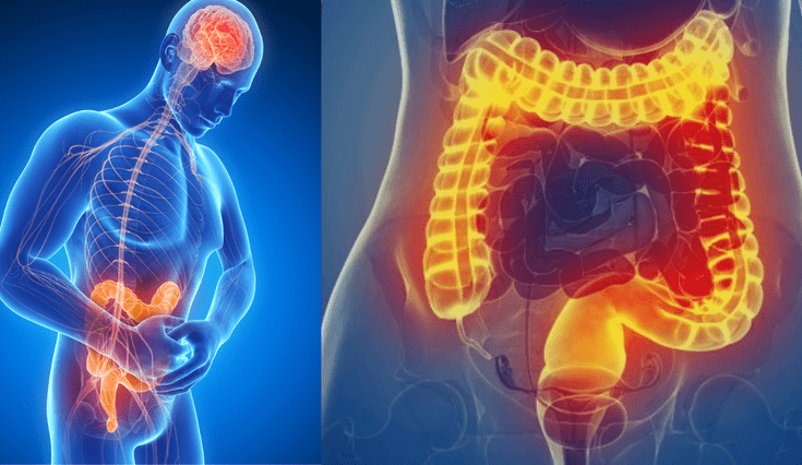 Descubre todo sobre esta enfermedad inflamatoria intestinal.