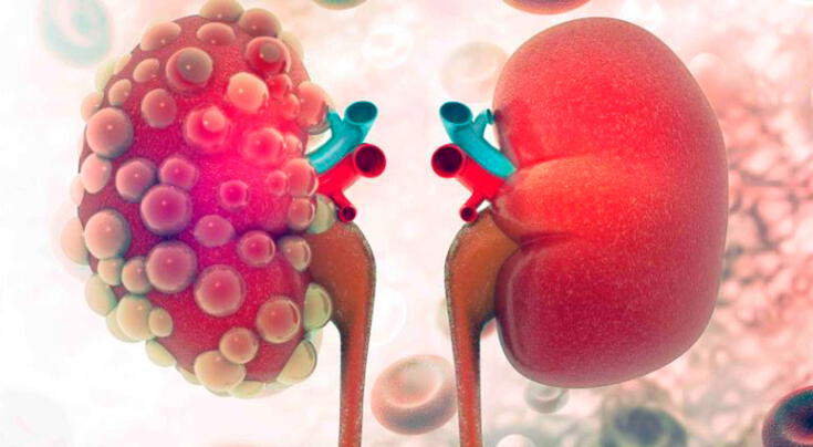 Qué es la insuficiencia renal y cómo detectarla a tiempo.