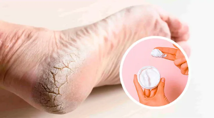 La crema para pies que hidrata y repara la piel seca.