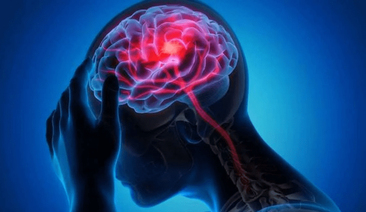 Las señales que pueden aparecer hasta un mes antes de un derrame cerebral.