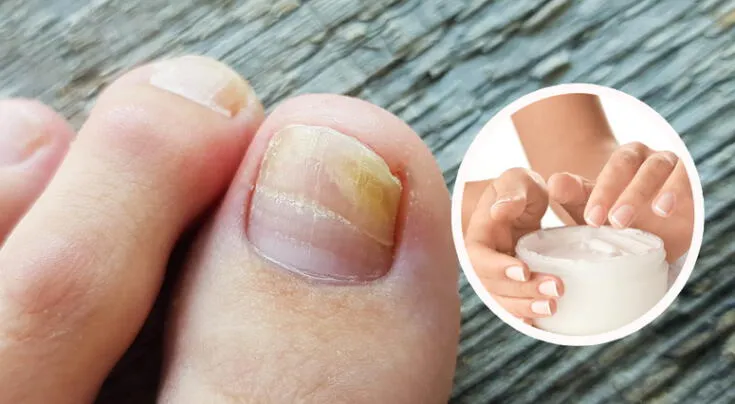 Tratamientos más efectivos para eliminar hongos en las uñas de los pies.