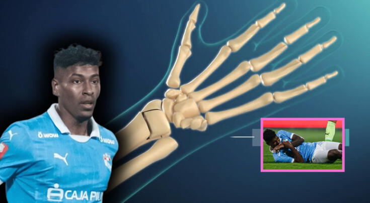 ¿Qué es la fractura de radio distal, causas y cómo prevenirla? Lesión que sufrió Miguel Araujo en el Sporting Cristal vs. Alianza Lima