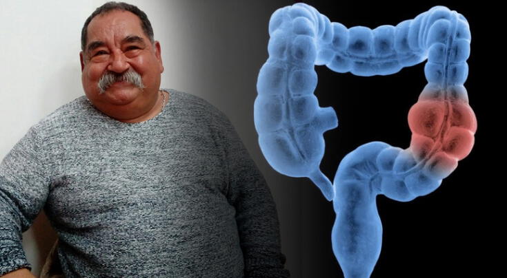 Expertos revelan qué tan letal es el cáncer de colon. Expertos revelan qué tan letal es el cáncer de colon.