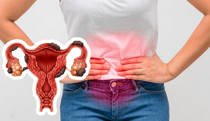 MINSA advierte de una enfermedad detrás de los cólicos menstruales.