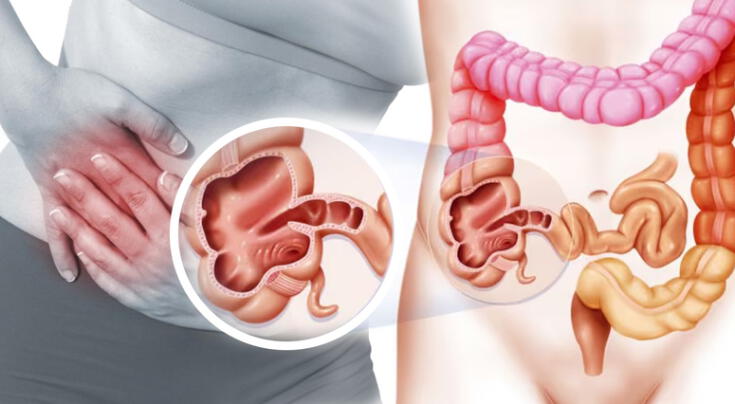 Expertos revelan si se puede vivir sin apéndice. Expertos revelan si se puede vivir sin apéndice.