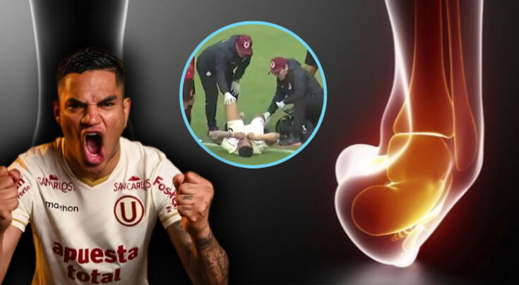 5 pasos para una recuperación más rápida del esguince de tobillo, lesión que sufrió Anderson Santamaría, jugador de Universitario de Deportes 5 pasos para una recuperación más rápida del esguince de tobillo, lesión que sufrió Anderson Santamaría, jugador de Universitario de Deportes