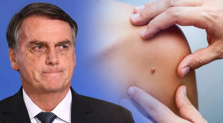 Cáncer de piel: síntomas, causas y tratamientos.