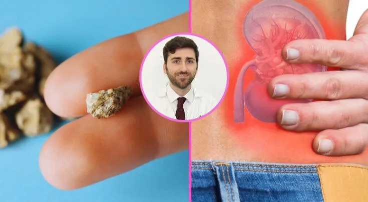 Piedras en los riñones: esto arruina tu salud renal y deberías dejar de consumirlo, según especialista