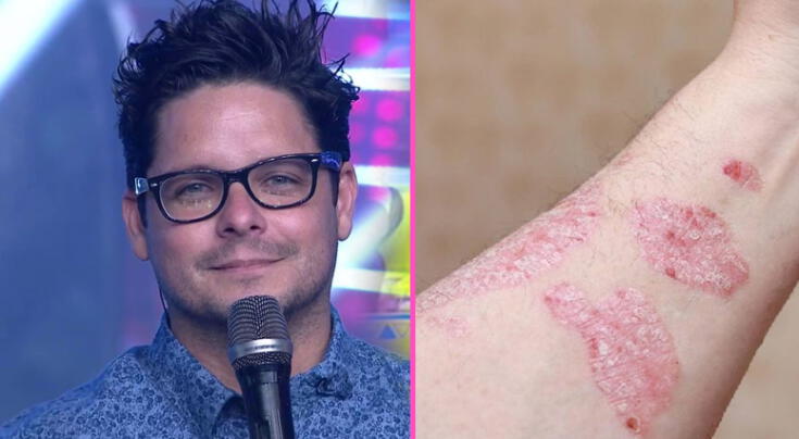 Gian Piero Díaz confiesa que enfrenta enfermedad crónica: qué es la psoriasis, síntomas, causas, tipos y tratamiento