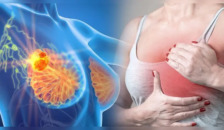 Cómo identificar signos de cáncer de mama. Cómo identificar signos de cáncer de mama.