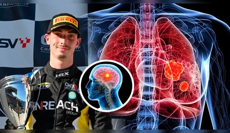 Qué tan letal es el diagnóstico de cáncer de pulmón y cerebro.